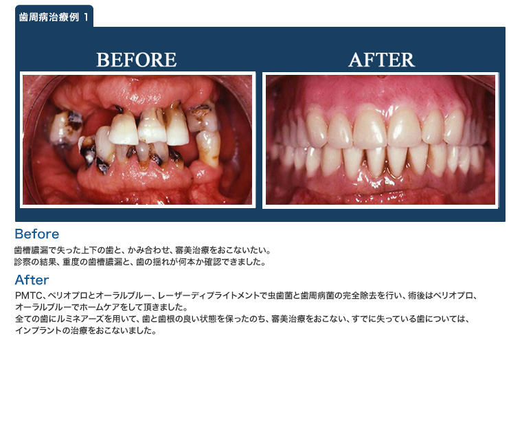 歯周病治療例